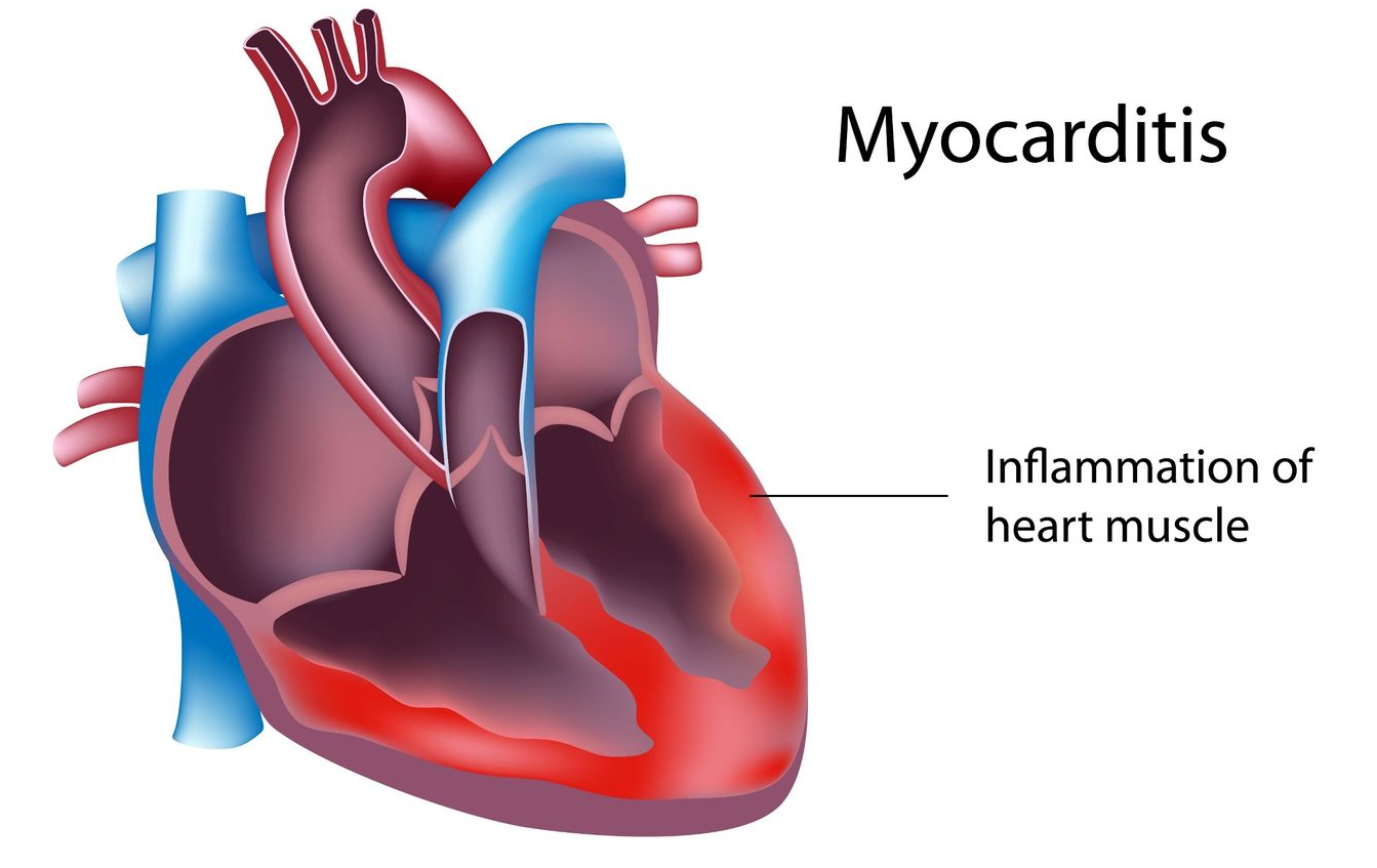 Viral myocarditis caused by Viral Infection of the hart