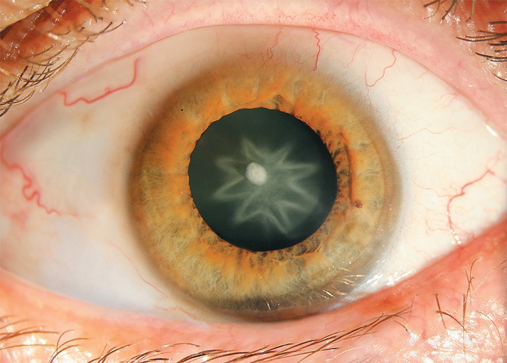 The star cataract strange medical case